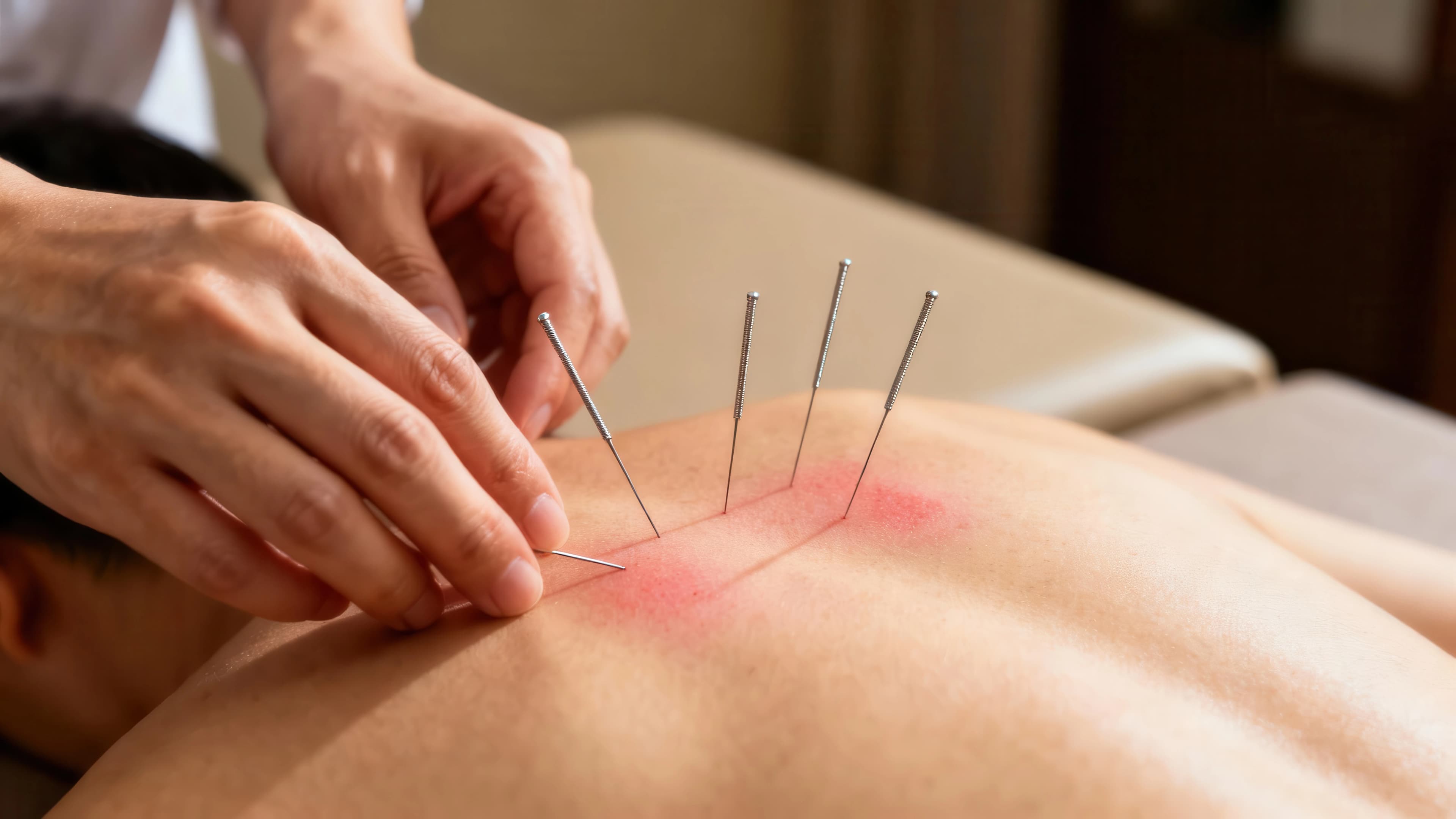 Dry Needling Therapy